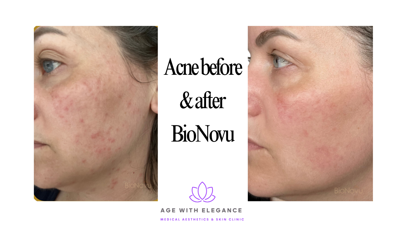 Before and after BioNovu