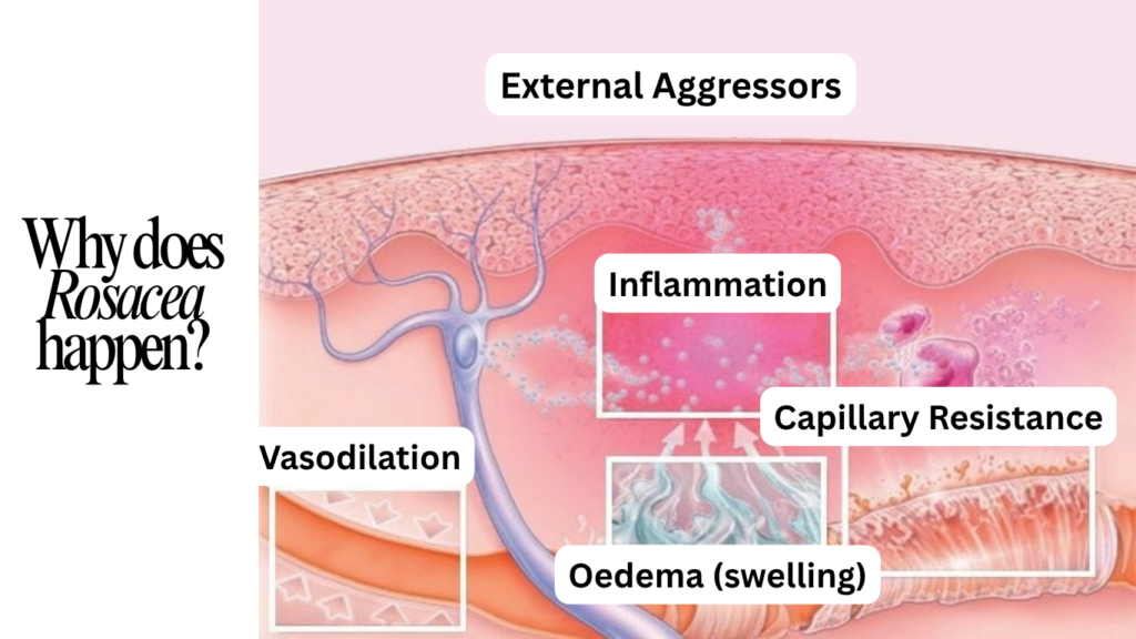 Undestand the pathology of rosacea