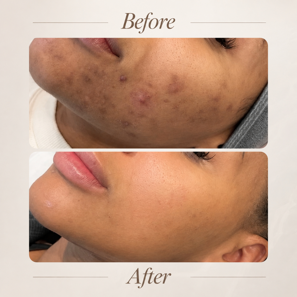 BioSpicule Therapy