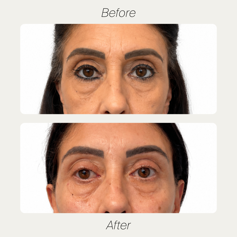 Christina before and after Plasma Fibroblast treatment