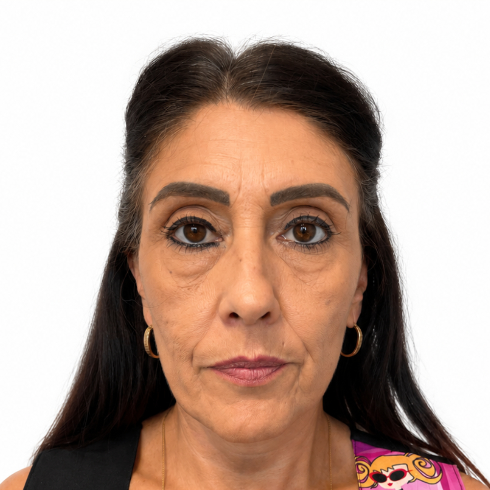 Christina before beginning treatment at Age With Elegance