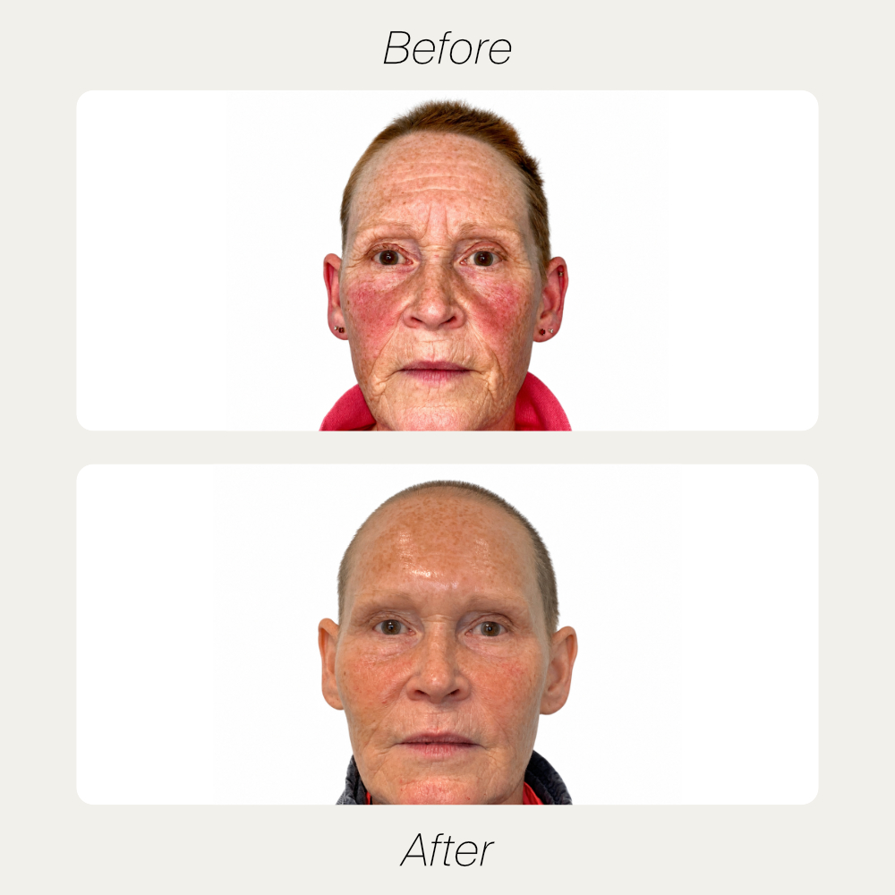 Cy before and after treatment comparison