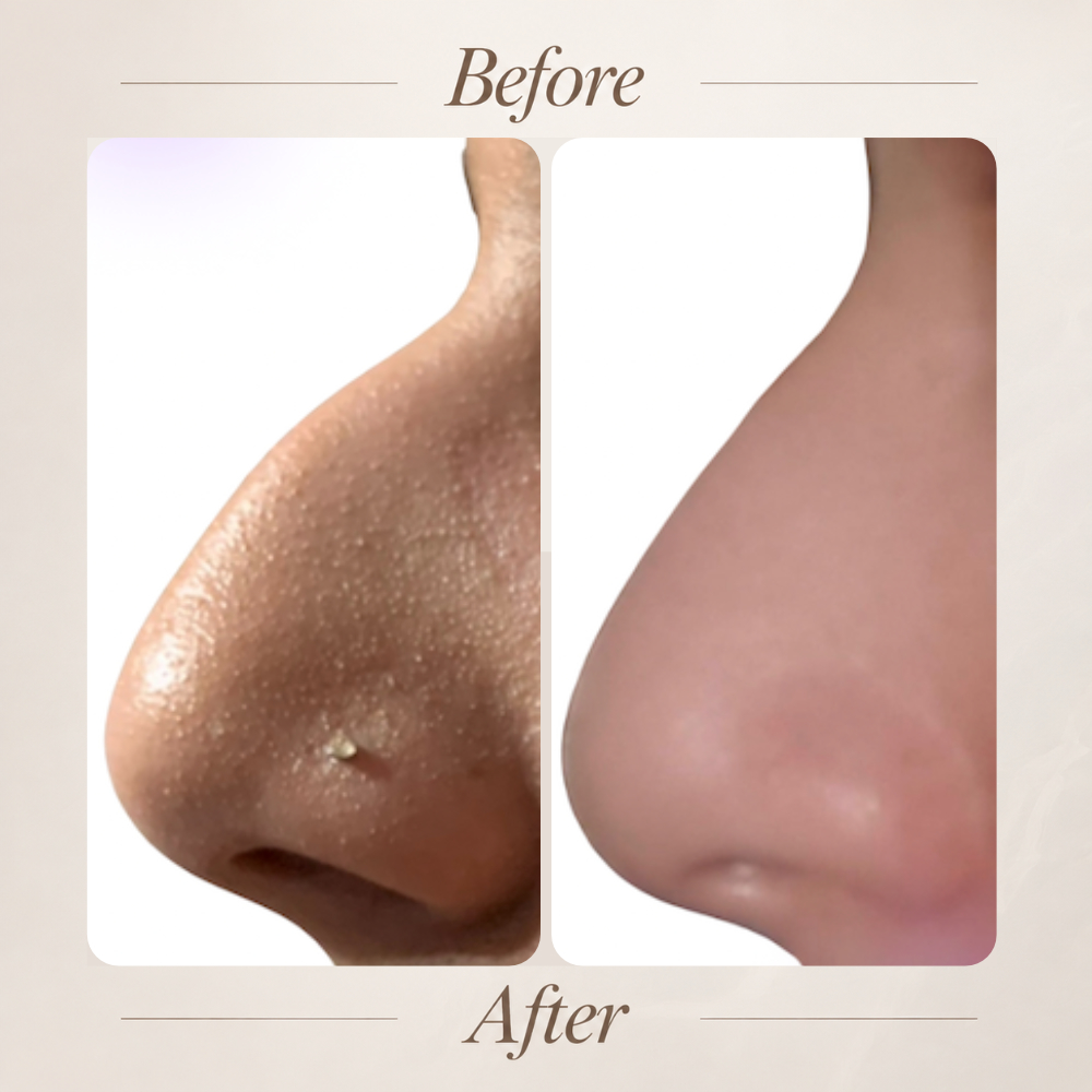Non-surgical rhinoplasty result