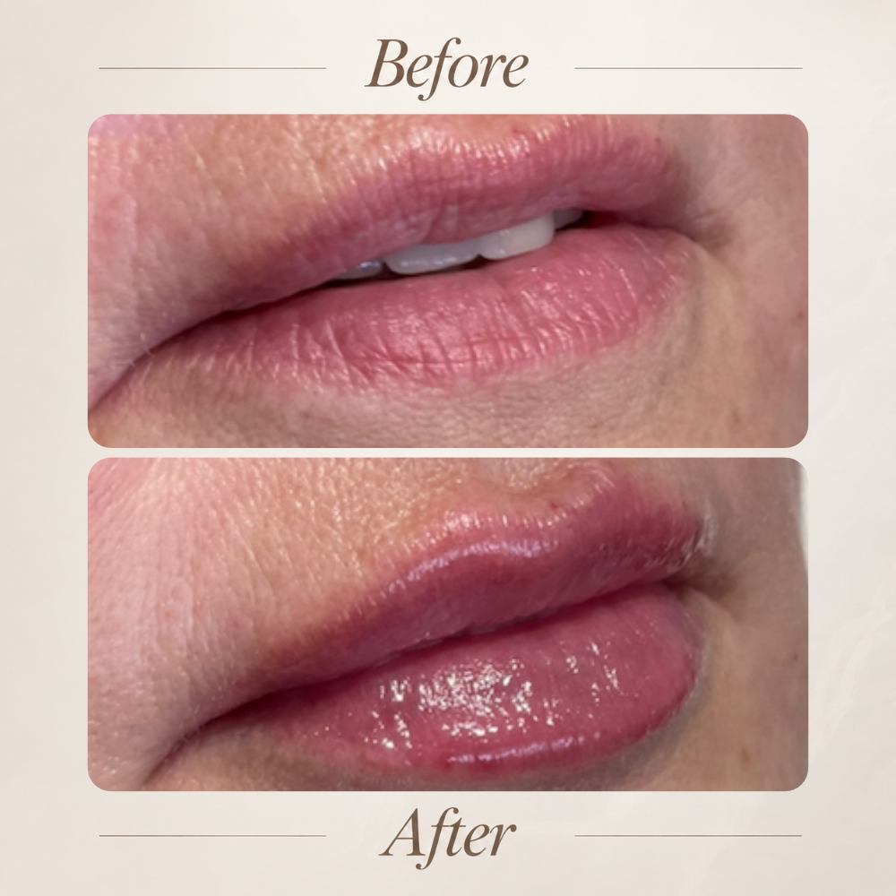 Subtle lip enhancement result
