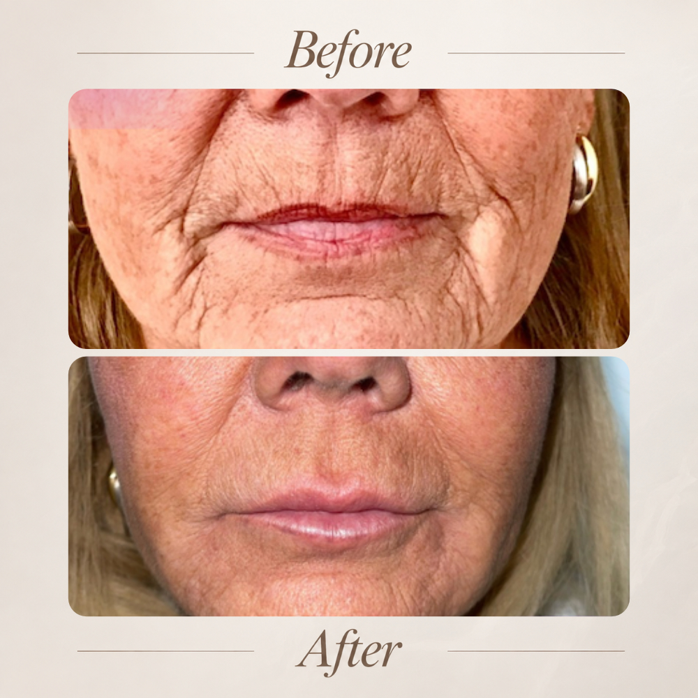 Nasolabial and marionette line filler before and after