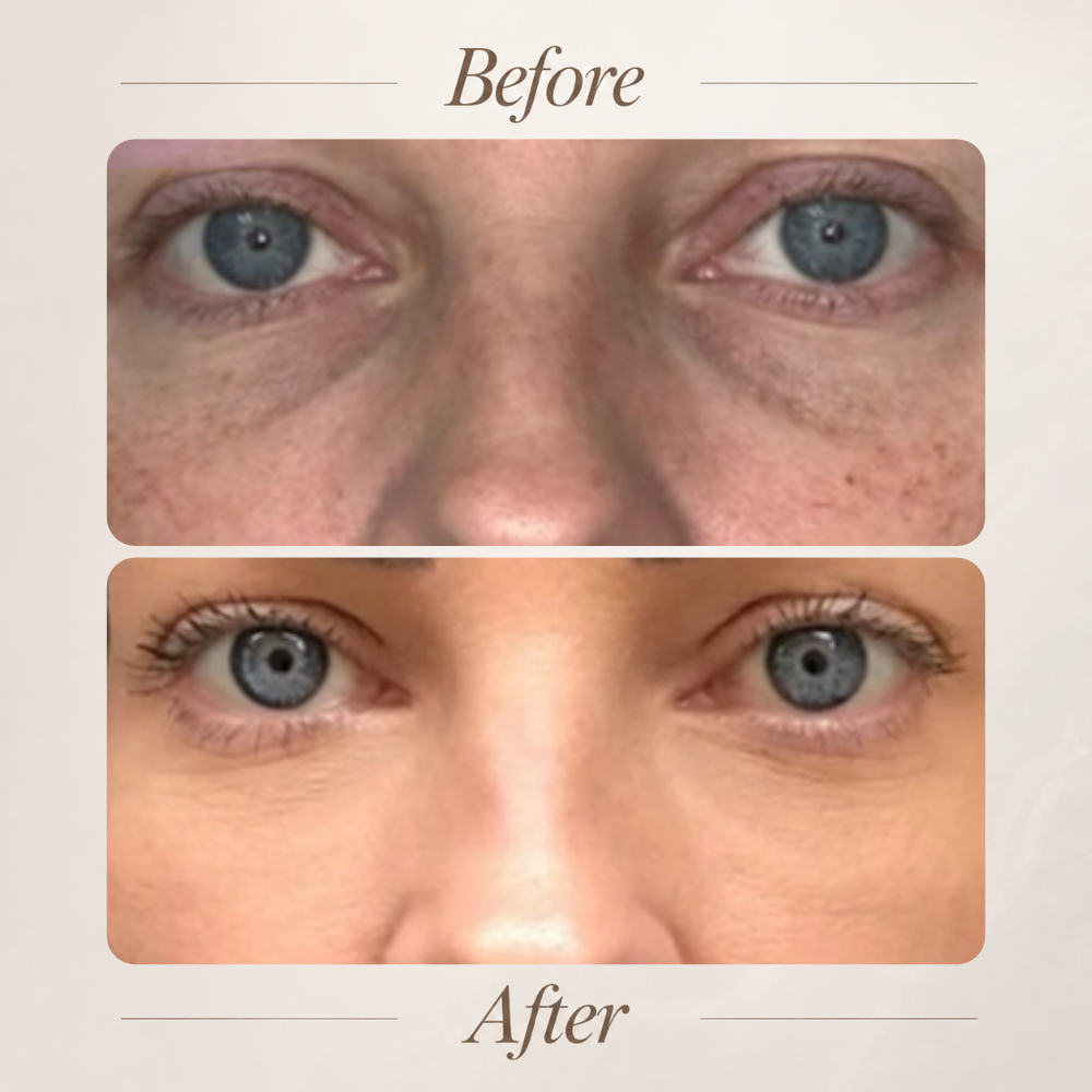 Under-eye treatment result