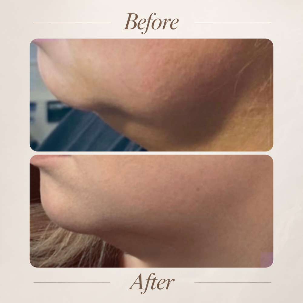 Deso Fat Dissolving Injections