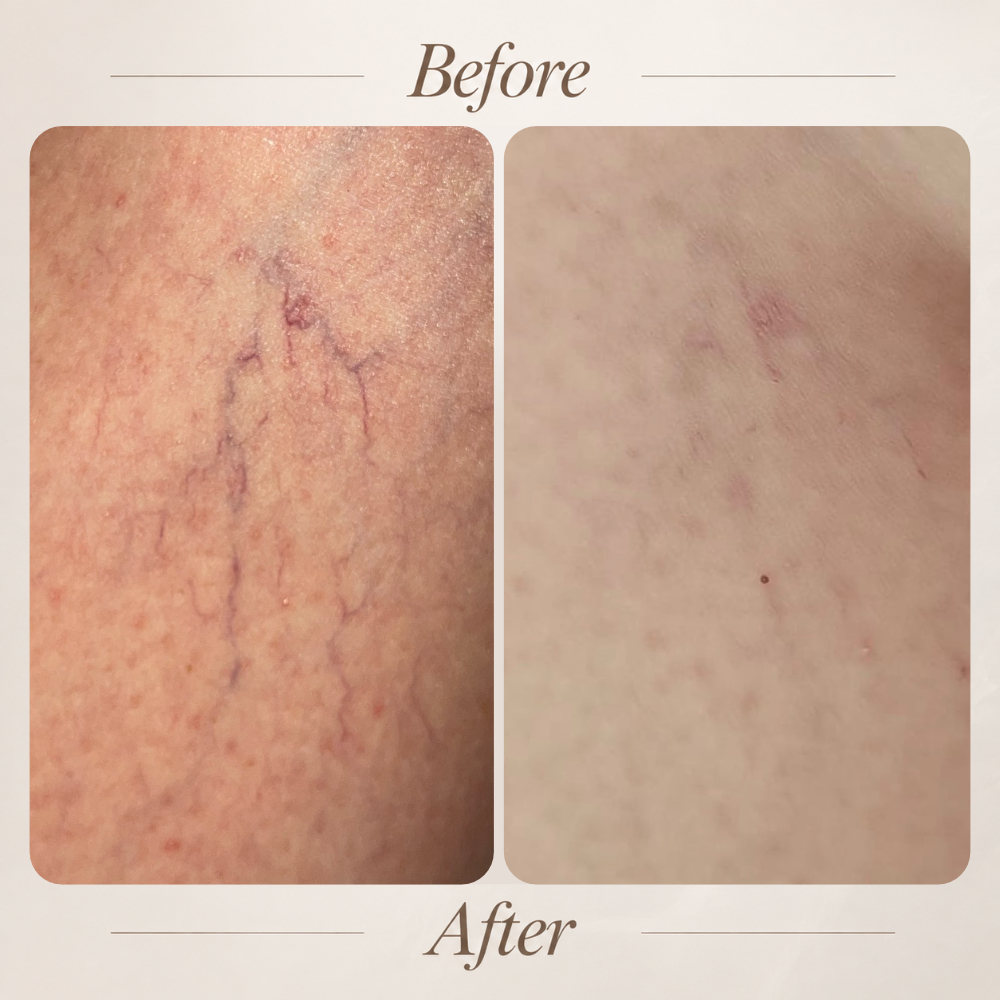 Microsclerotherapy thread vein treatment