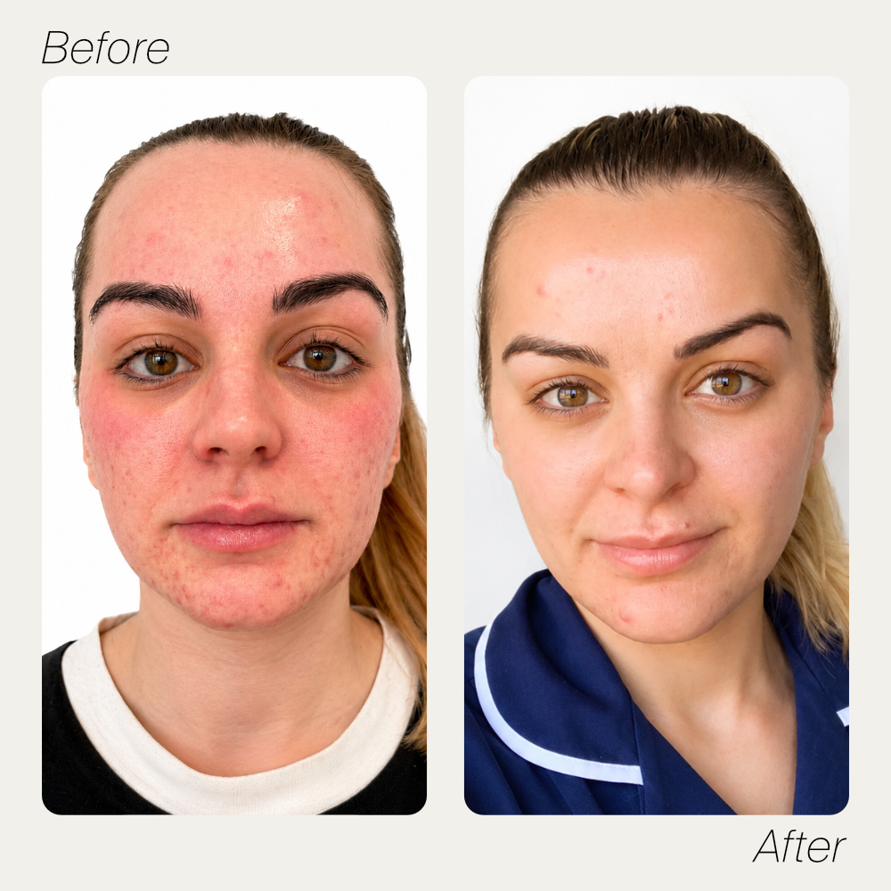 Victoria before and after skin resurfacing treatment