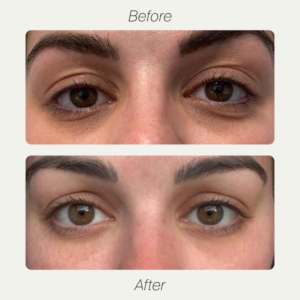 Victoria before and after under-eye rejuvenation treatment