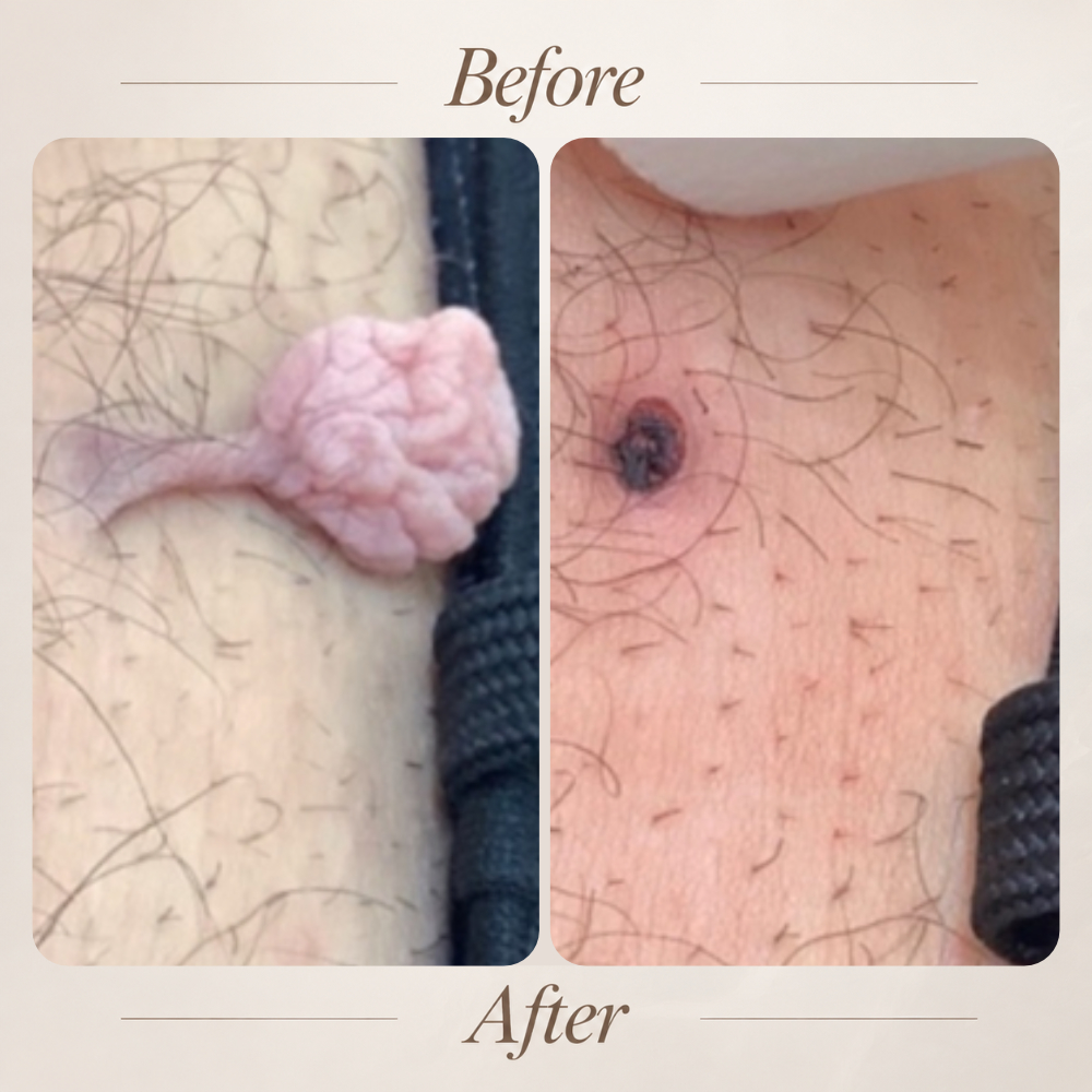Plasma Fibroblast treatment
